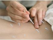 Acupuncture May Ease Overactive Bladder